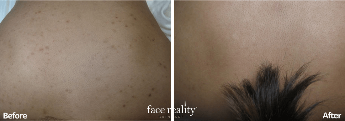 Acne Treatment - Before and After - 4
